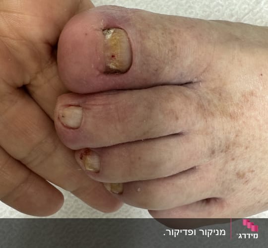 טיפול בציפורניים בכף רגל עם בעיות עור